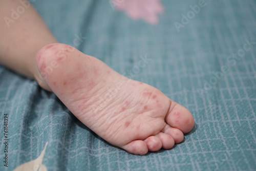 close up view of child's feet infected with hand feet and mouth disease or HFMD originating from enterovirus or coxsackie virus, zoom shot.