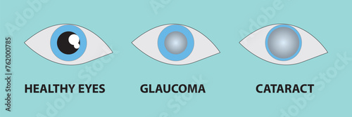 illustration of a healthy eye, glaucoma, cataract