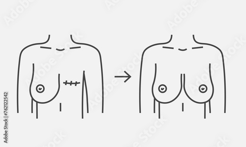 Mastectomy breast cancer and breast reconstruction. Mammary cancer, mastectomy. Vector illustration