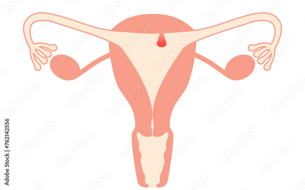 Diagrammatic illustration of endometrial polyps, anatomy of the uterus and ovaries