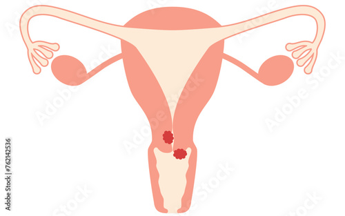 Diagrammatic illustration of cervical cancer, anatomy of the uterus and ovaries