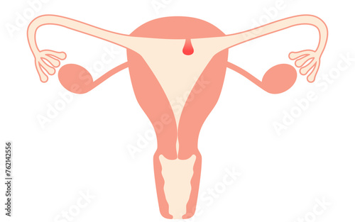 Diagrammatic illustration of endometrial polyps, anatomy of the uterus and ovaries