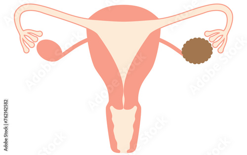 Diagrammatic illustration of ovarian cysts, anatomy of the uterus and ovaries