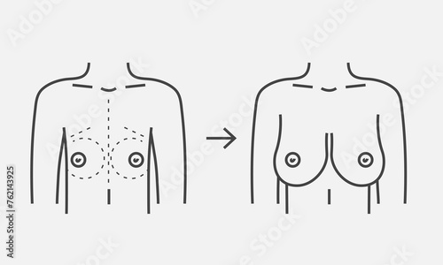 Female breast before and after augmentation line icon. Plastic surgery breast size correction. Vector illustration