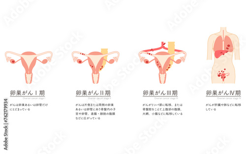 Diagrammatic illustration of stage I ovarian cancer, anatomy of the uterus and ovaries