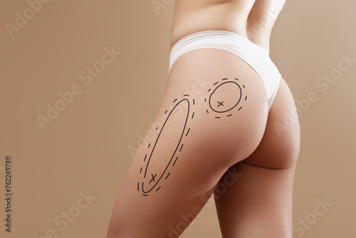 Overweight woman with fat cellulite legs and buttocks, before after concept, obesity female body with painted surgical lines and arrows, rear view