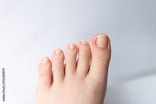 Close-up photo of an ingrown toenail, showing discomfort and potential pain. photo