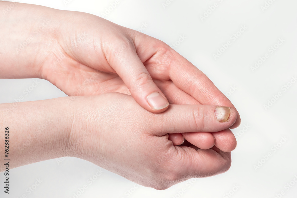 A nail in need of treatment for a fungal infection. Fungal diseases of parts of the body A nail in need of treatment for a fungal infection. Fungal diseases of parts of the body
