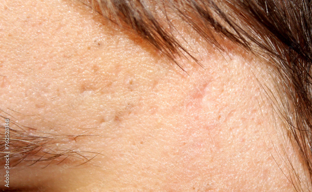 Skin with acne scars. Stock human skin texture in the best quality. Photo with scars. Skin with acne scars. Stock human skin texture in the best quality. Photo with scars.