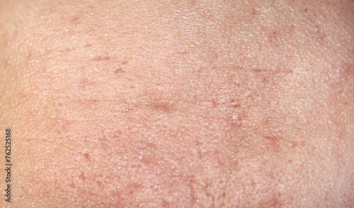 Problem skin with acne marks. Stock human skin texture in the best quality. Photo with scars.