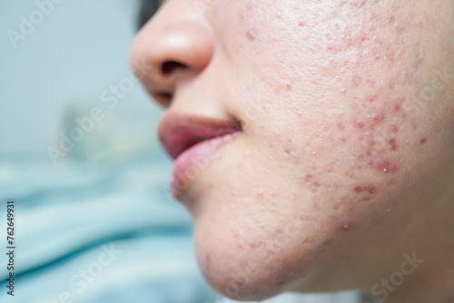 Close up detail photo of The face of an Asian woman who has many pimples on her cheeks. Hormonal acne, puberty and before menstruation.  photo