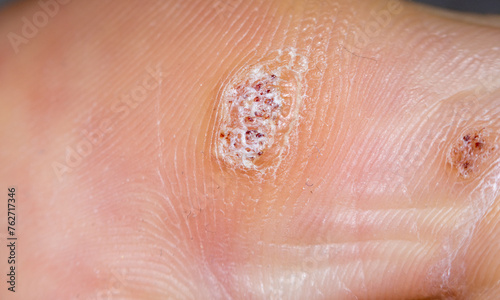 Bild auf Leinwand Plantar wart close up on the bottom of a big toe caused by the human papillomavi