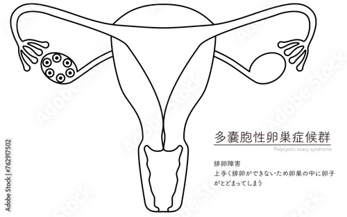 多嚢胞性卵巣症候群（排卵障害）の図解イラスト、子宮・卵巣の解剖図