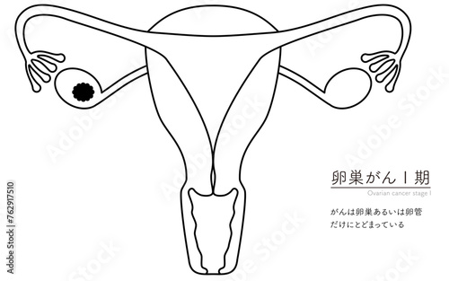卵巣がんI期の図解イラスト、子宮・卵巣の解剖図