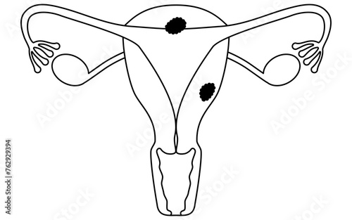 Illustrative illustrations of Endometrial cancer, anatomy of the uterus and ovaries