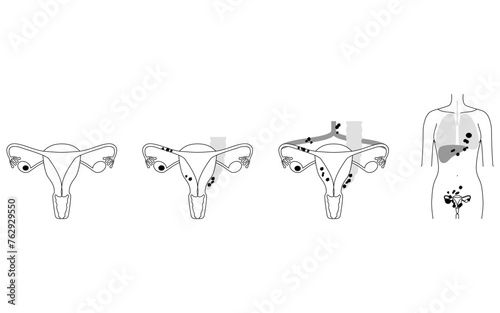 Diagrammatic illustration of stage I ovarian cancer, anatomy of the uterus and ovaries