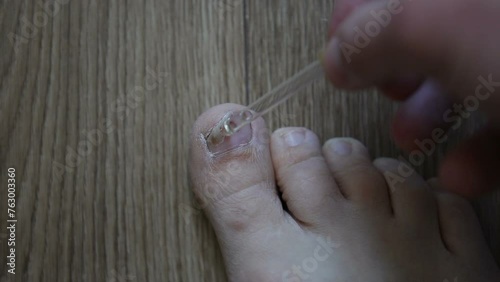 Onycholysis - detachment of the nail from the soft tissues of the finger. Disease of the nail plate on the big toe. Toenail fungus treatment. photo