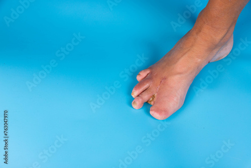 Amputation of diabetic toes of a person on a blue background. Selective focus. photo