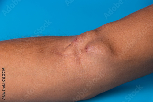 Fistula on the arm as a result of an operation for hemodialysis with kidney failure. photo