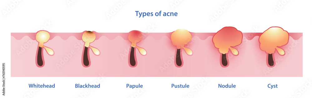 Types Of Acne Vector On White Background Formation Of Noninflammatory Types Of Acne Vector On White Background Formation Of Noninflammatory