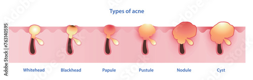 Types of acne vector on white background. Formation of noninflammatory acne, whitehead, blackhead, inflammatory acne, papule, pustule, nodule and cyst. Skin care and beauty concept illustration. photo