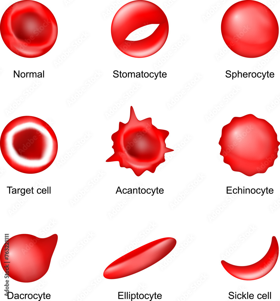 Shape of red blood cell. Sickle cell, Echinocyte, Spherocyte ...