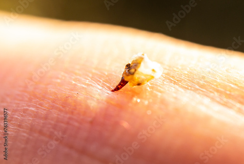 A bee stung a man's finger.  Bee sting trying to remove from the human body