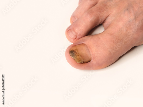 Inflamed and broken male toenail on white background.