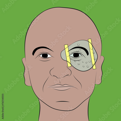 Eye protector, prevents blows and particles from entering the eye.