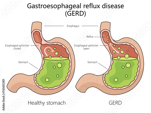 Human gastroesophageal reflux disease structure diagram hand drawn schematic vector illustration. Medical science educational illustration