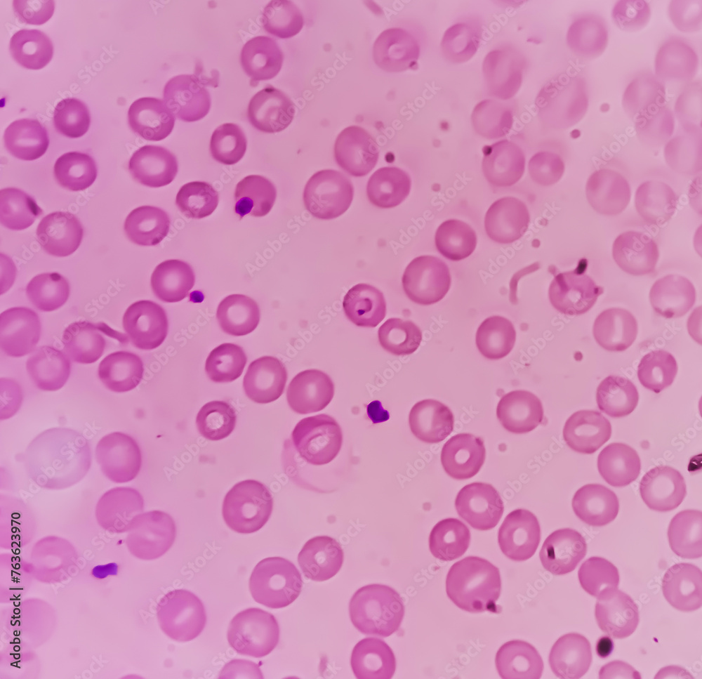 Malarial Parasite(MP) Test, Medical check up test, to identified by examining under the microscope a drop of the patient's blood, spread out as a blood smear on a microscope slide.