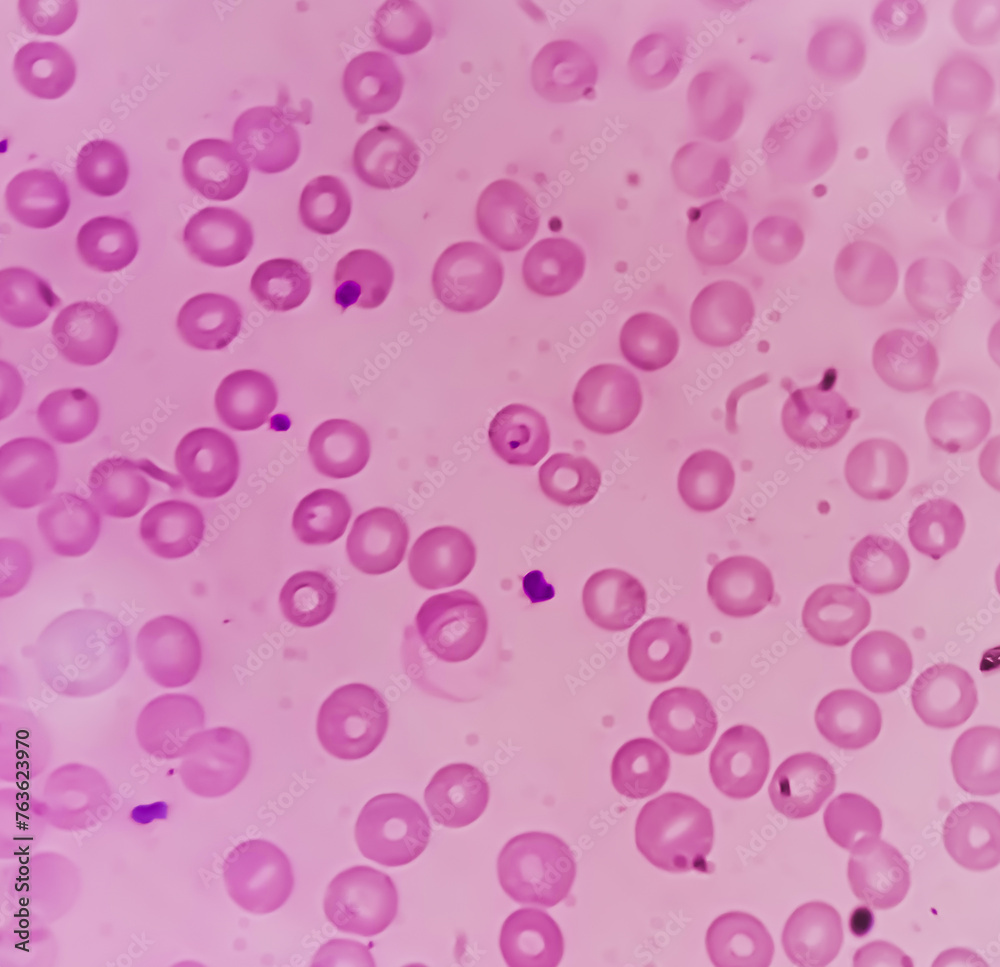 Malarial Parasite(MP) Test, Medical check up test, to identified by examining under the microscope a drop of the patient's blood, spread out as a blood smear on a microscope slide. Malarial Parasite(MP) Test, Medical check up test, to identified by examining under the microscope a drop of the patient's blood, spread out as a blood smear on a microscope slide.