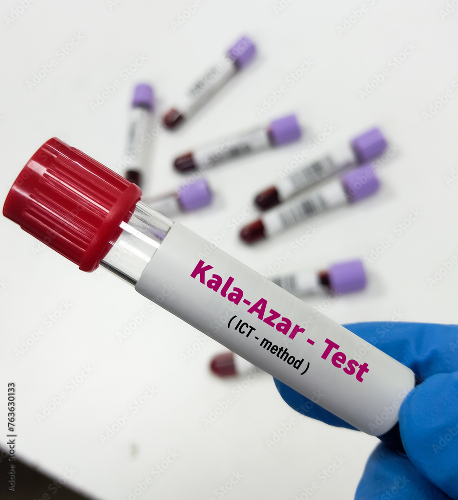 Blood sample for Kala-azar test with laboratory background. Visceral ...
