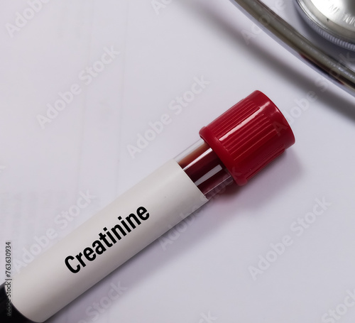 Blood sample for Serum Creatinine test. Diagnosis of kidney or renal disease.