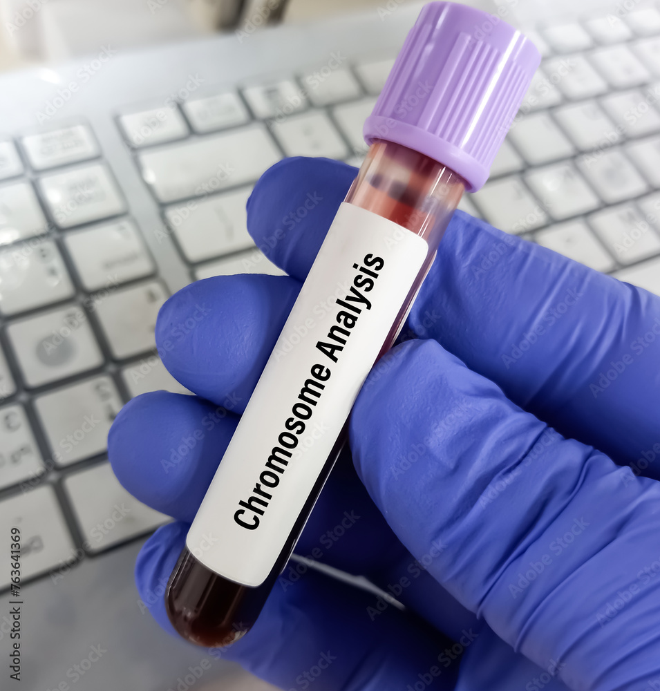 Blood sample for Chromosomal analysis karyotype testing with patient
