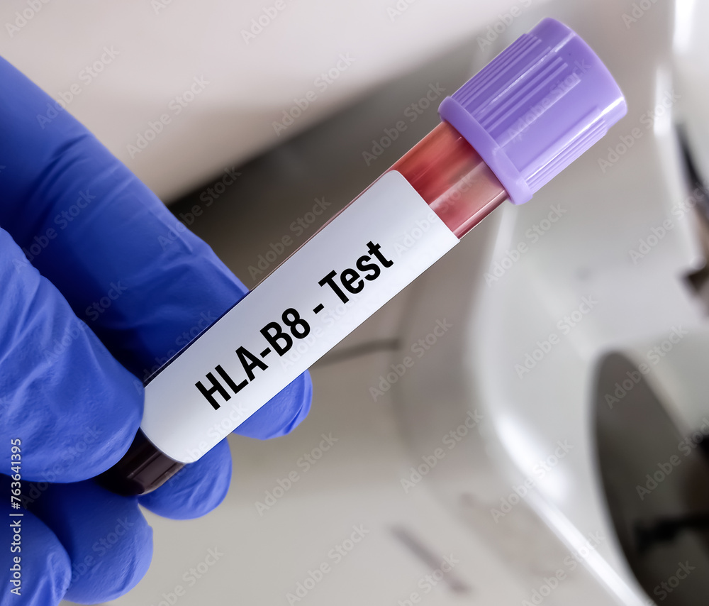 Test tube with blood sample for HLA-B8 (Human Leukocyte Antigen-B8) test. Test tube with blood sample for HLA-B8 (Human Leukocyte Antigen-B8) test.