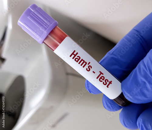 Blood sample for HAM'S Test to diagnose paroxysmal nocturnal hemoglobinuria (PNH). photo