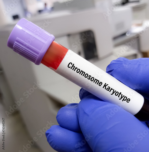 Blood sample for Chromosomal analysis karyotype testing with patient report, study for abnormal chromosome. photo