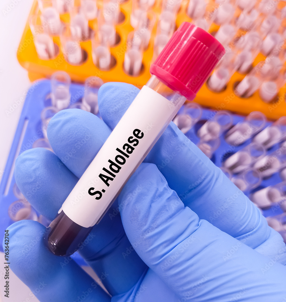 Scientist hold blood sample for Serum Aldolase test to diagnosis of muscle or organ damage, focus view. Scientist hold blood sample for Serum Aldolase test to diagnosis of muscle or organ damage, focus view.