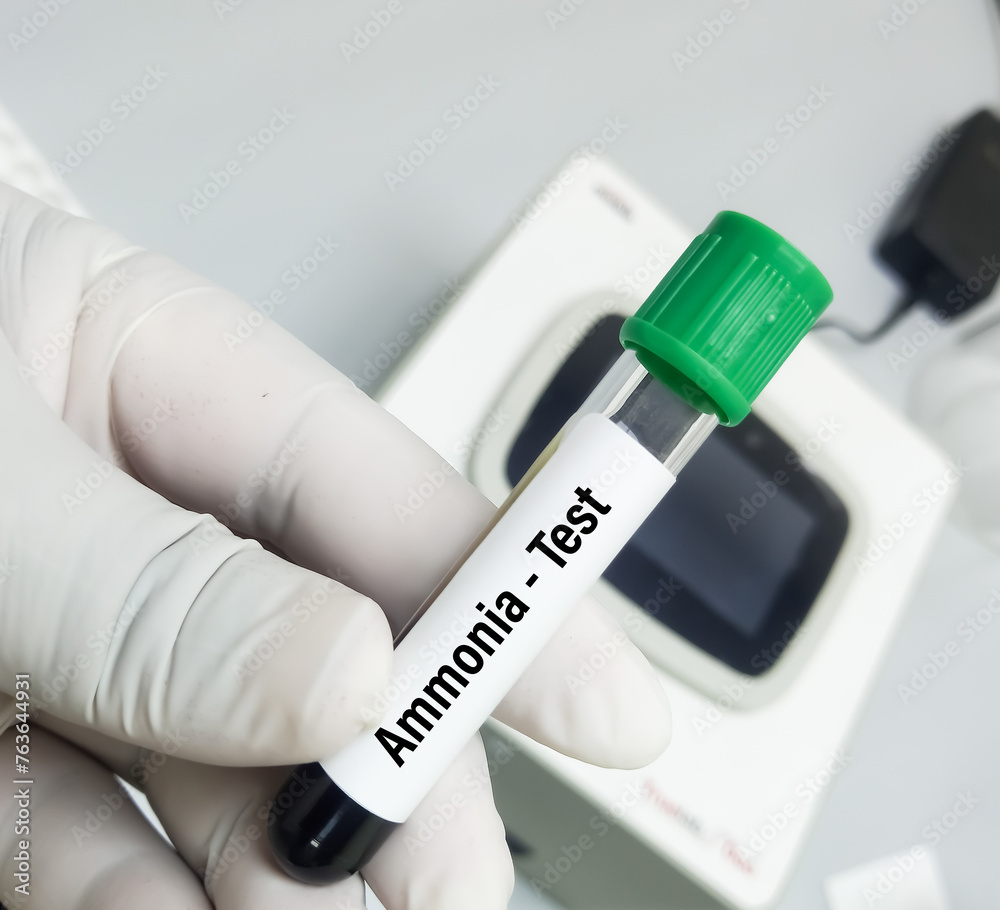 Blood Sample For Ammonia Test To Diagnosis Of Ammonia Levels Also Known As Hyperammonemia Urea Blood Sample For Ammonia Test To Diagnosis Of Ammonia Levels Also Known As Hyperammonemia Urea