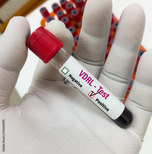 Blood sample for VDRL test, RPR, Syphilis screening test. To diagnosis Syphilis and Gonorrhea, STD disease. photo