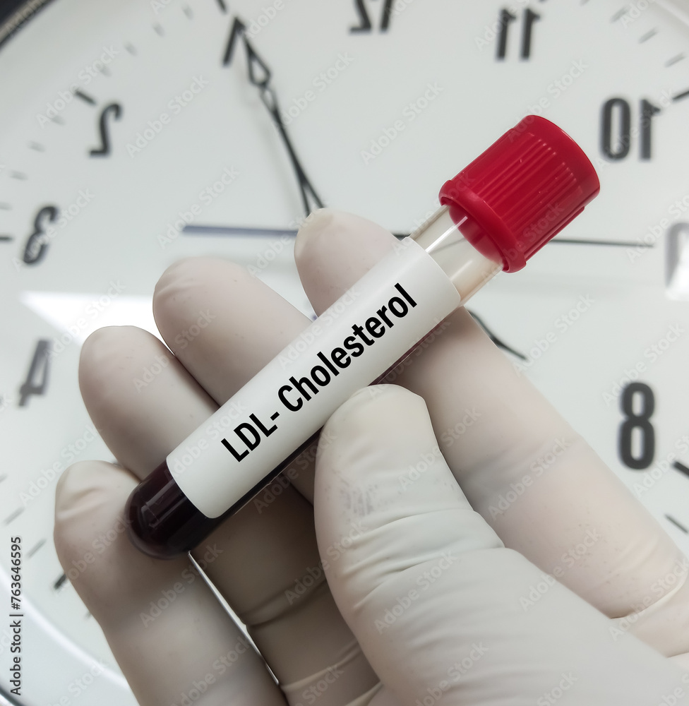 Photo & Art Print Blood sample for LDL cholesterol test, (Fasting Lipid ...