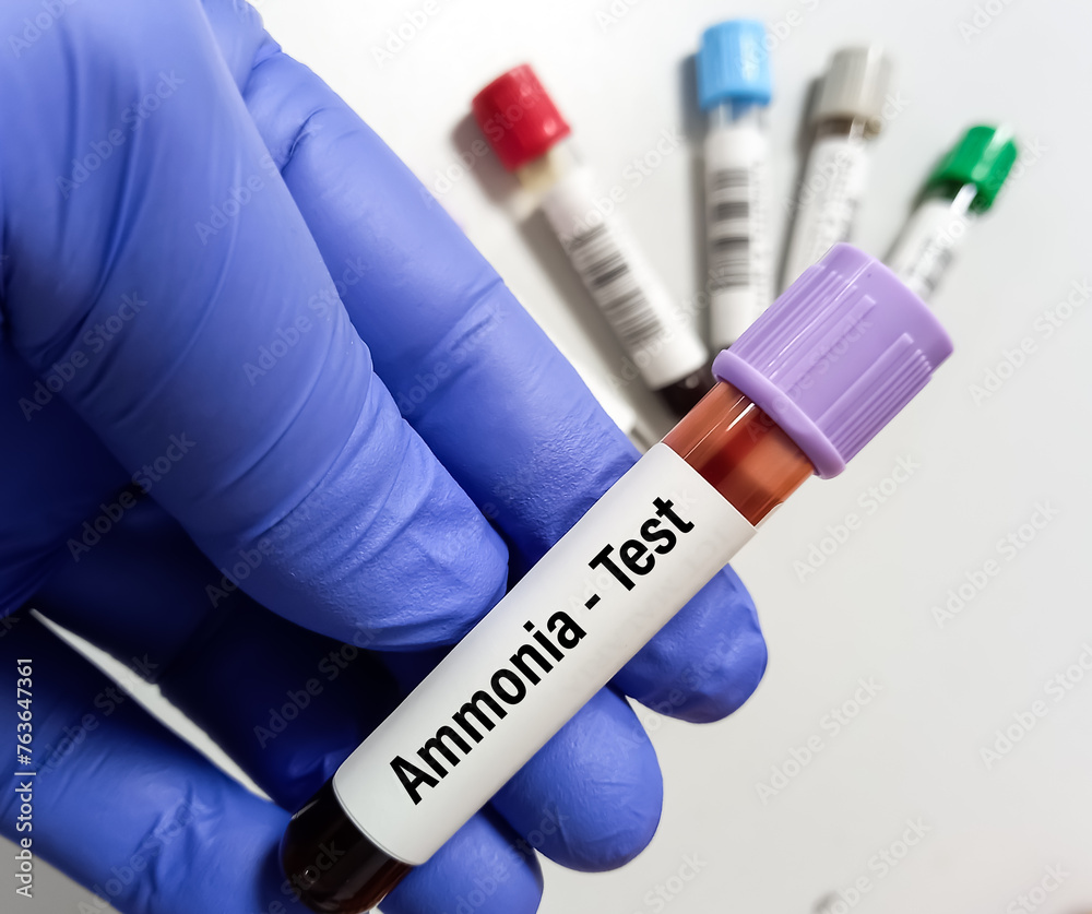 Blood Sample For Ammonia Test To Diagnosis Of Ammonia Levels Also Known As Hyperammonemia Urea Blood Sample For Ammonia Test To Diagnosis Of Ammonia Levels Also Known As Hyperammonemia Urea