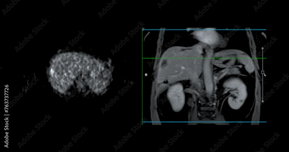 PET MRI of the liver provides detailed imaging for detecting liver ...