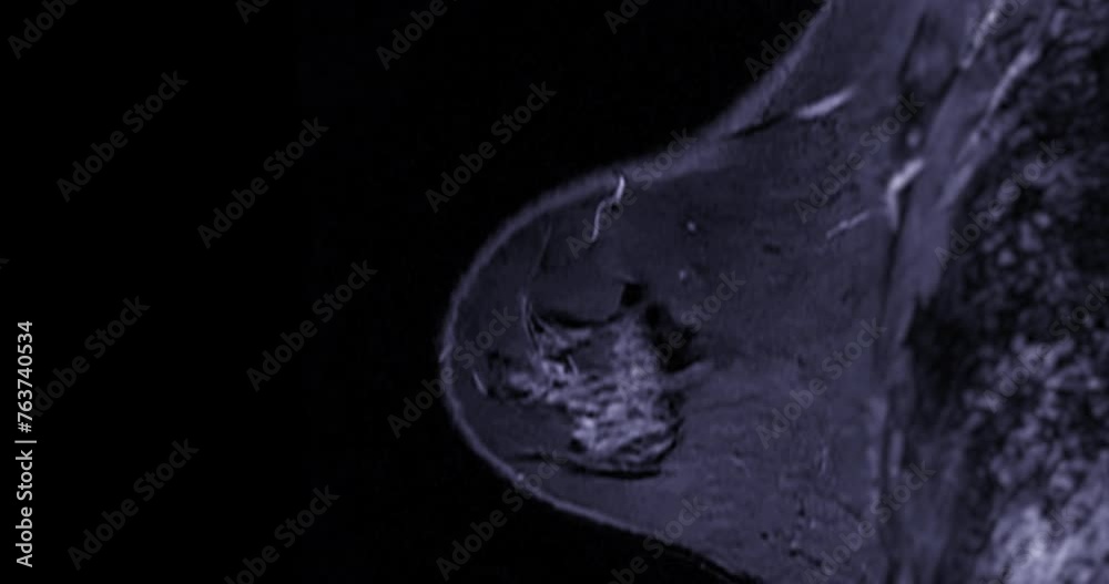 bi rads category 4 suspicious findings