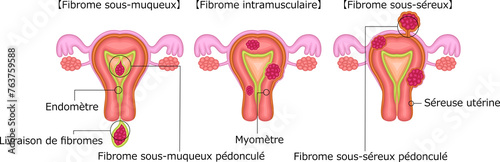 子宮筋腫　分類　イラスト　フランス語 photo