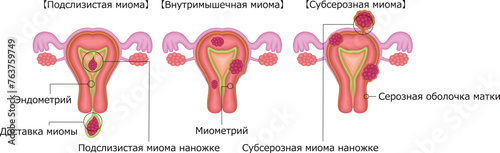 子宮筋腫　分類　イラスト　ロシア語