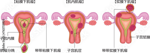 子宮筋腫　分類　イラスト　中国語
