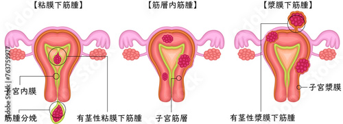 子宮筋腫　分類　イラスト　日本語