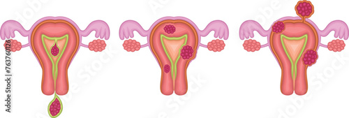 子宮筋腫　分類　イラスト